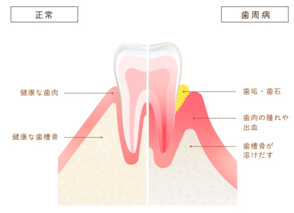 健康な歯と歯周病の歯