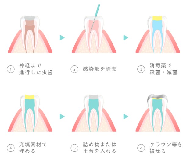 根管治療の流れのイラスト図