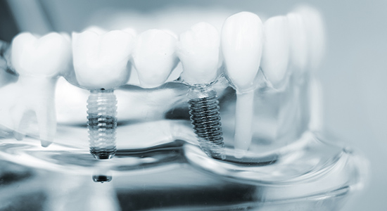 インプラントを埋め込んだ歯の模型