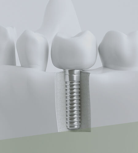 インプラントのイメージ